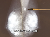 がんは怖い・でも怖くない　～乳がん～